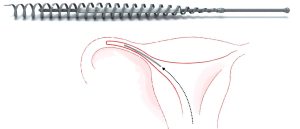 Essure diagram 300x129 - Essure Permanent Contraceptive Device